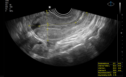 medical diagnostics : UterineAssist™