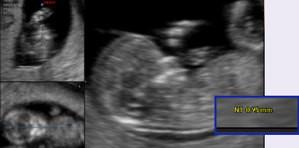 5d ultrasound : 5D NT™